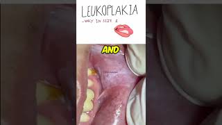 Oral Leukoplakia  Dentogenesis [upl. by Rovaert]