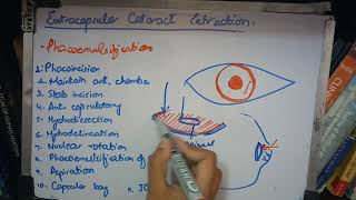 EXTRACAPSULAR CATARACT EXTRACTION part 1 PHACOEMULSIFICATION made so easy [upl. by Anaer]