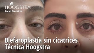 Blefaroplastía sin cicatrices  Técnica Hoogstra  23236 [upl. by Rivi]