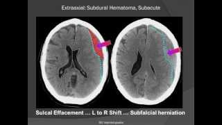 Subdural Hematoma SDH [upl. by Dorita]