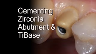 Dental Zirconia Implant Abutments [upl. by Crain]