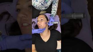 Microneedling Procedure amp Tutorial [upl. by Virginia]