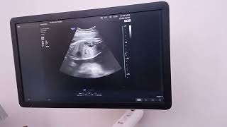 hydronephrosis with hydroureter of Rt kidney [upl. by Uni]