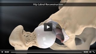 Hip Labral Reconstruction [upl. by Rafi]