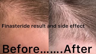 Finasteride resultFinasteride Aide effectFinasteride use Karna chahiye ya nahi [upl. by Muncey]