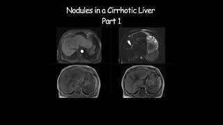 Nodules in a Cirrhotic Liver  Part 1 radiology radiologist cirrhosis liverdisease liverhealth [upl. by Ddot896]