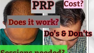 PRP for hair losshow it workscostDOs ampDonts [upl. by Eiliah]