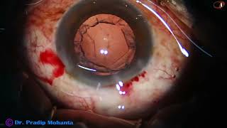 Direct vertical chop and use of Coaxial irrigation amp aspiration  Dr Pradip Mohanta 6th Nov 2024 [upl. by Anaert]