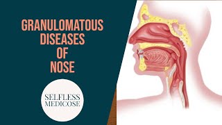 GRANULOMATOUS DISEASES OF NOSE part 1 Rhinoscleroma and syphylis in detail [upl. by Windham]