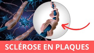 Sclérose en Plaques  Symptômes Diagnostic Traitement [upl. by Pinebrook472]