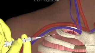 Subclavian Vein Access  Hypovolemic Patient  Animation by Cal Shipley MD [upl. by Anytsirk]