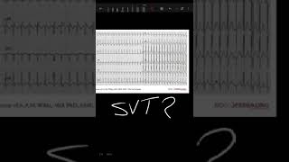 اسمها SVT ولا AVNRT [upl. by Nikolas]