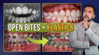 Anterior OPEN BITE  Elastics [upl. by Pedrick366]