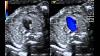 Tetralogy of Fallot with pulmonary atresia [upl. by Graner]