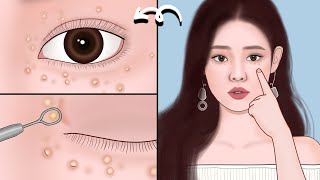 The safe way to remove milia around eyes  ASMR eye milia removal animation  Mengs Stop Motion [upl. by Colp795]