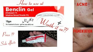 Benclin gel Honest review 💓⭐ Acne treatment [upl. by Kyla813]