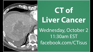 Facebook Live CT of Liver Cancer [upl. by Aynik]