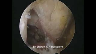 ALL INSIDE PCL RECONSTRUCTION USING PERONEUS LONGUS AUTOGRAFT [upl. by Colwen]