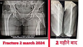 femur bone fracture recovery update after 8 months [upl. by Acassej]