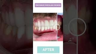 What Do Dental Crowns Look Like​ See Yourself  Longevita [upl. by Dich]