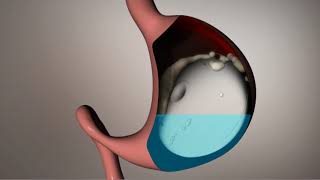 Elipse balloon for weight loss  Spire Healthcare [upl. by Anak41]