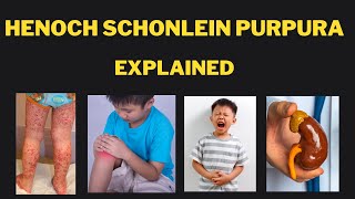 Henoch Schonlein Purpura IgA vasculitis Pathophysiology presentations investigations and treatment [upl. by Lotty330]