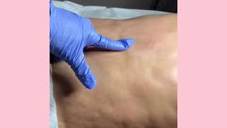 Fibrosis Treatment after liposuction [upl. by Onaicul]