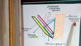 Direct vs Indirect Inguinal Hernia  Malang Medicose [upl. by Nodaj]