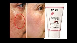 Jovees Anti Blemishes Pigmentation Cream pigmentation ka 100 Elaj Agar pigmentation se paresan h [upl. by Strohbehn452]