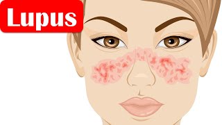 Lupus SLESystemic Lupus Erythematosus  Causes Pathogenesis Symptoms Diagnosis Treatment [upl. by Udale577]