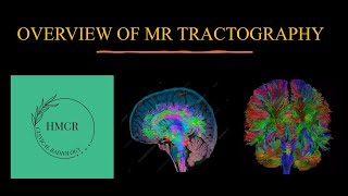 MR TRACTOGRAPHY DIFFUSION TENSOR IMAGING DTI  WHITE MATTER TRACTS ON MRI [upl. by Anallise232]