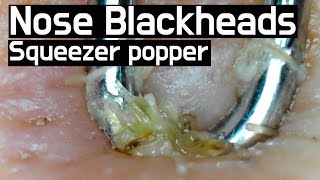 30 Pull out Blackheads on nose squeezer popper Whiteheads Close up 150X  non sound FX ver [upl. by Elisee]