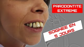 Soigner la parodontite avec perte de gencive  Implants dentaires basales non invasif [upl. by Cumings]