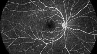 Fundus fluorescein angiography FFA [upl. by Elleirad701]