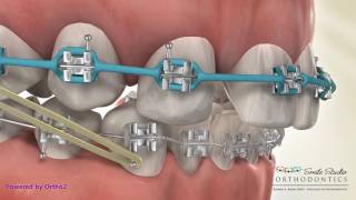 Canine Substitution  Missing Lateral Incisor [upl. by Maribeth343]