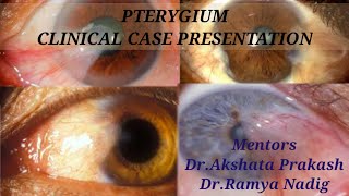 PTERYGIUM [upl. by Bodi]