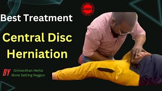 A Central Disc Herniation Is A Rare Condition  Disc Herniation Recovery [upl. by Meredith]