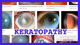 keratopathy [upl. by Mehs]