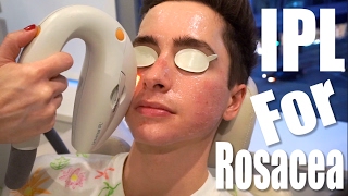 Rosacea Treatment with IPL Laser ft Eric Smith [upl. by Iraam979]