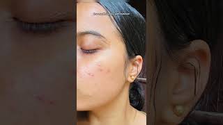 Tretinoin cream review  acne scar cream viralshorts skincare skincaretips skincareroutine [upl. by Nirual]