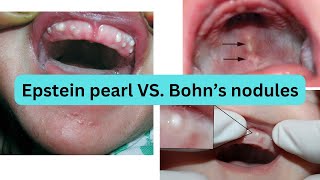 EPSTEIN PEARL vs BOHNS NODULES Whats the difference [upl. by Cecilla]