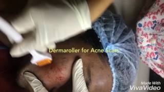 Acne Scar Treatment in Delhi IndiaDermaroller treatment in Delhi amp Gurgaon [upl. by Eiggem684]