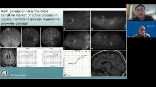 Susac syndrome Fluorescein Angiogram findings [upl. by Latoya]