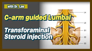 lumbar L5 transforaminal L5S1 facet joint injection C arm lecture amp clinical case [upl. by Nahsrad]