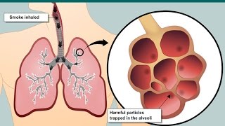 Smoking and emphysema [upl. by Nudd121]