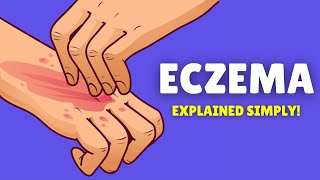 What is Eczema  Causes Signs and Symptoms Diagnosis and Treatment [upl. by Haron]