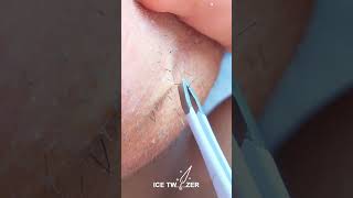 Satisfying Chin Hairs Plucking With Tweezer  Female Facial Hairs Removal PCOS Fighter [upl. by Rebmeced]