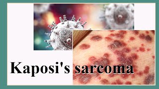 Kaposis sarcoma [upl. by Chadwick519]