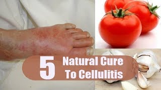 5 Home Remedies for Cellulitis  By Top 5 [upl. by Eirol]