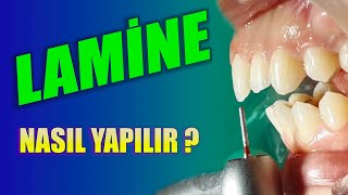 Lamine Diş Nedir  Lamine Diş Kesimi Nasıl Yapılır [upl. by Strickman]